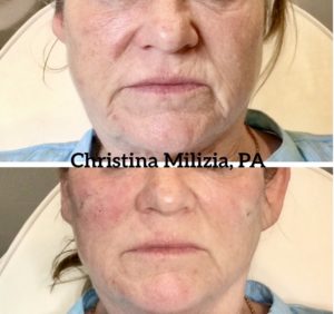 Before and After result Facial Filler Rejuvenation | A Nu U Aesthetics at Congers, New York