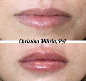 Before and After result Lip Filler | A Nu U Aesthetics at Congers, New York