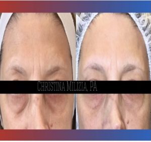 Before and After result Morpheus 8 | A Nu U Aesthetics at Congers, New York