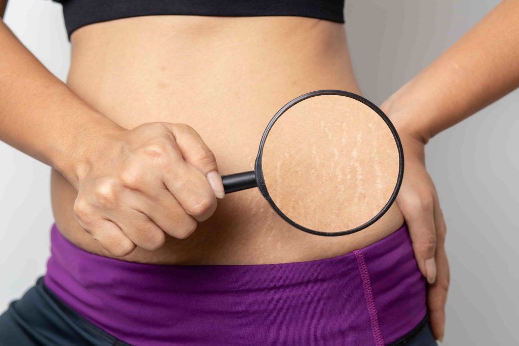 How can I get rid of stretch marks permanently? 7 How can I get rid of stretch marks permanently? | A Nu U Aesthetics at Congers, New York