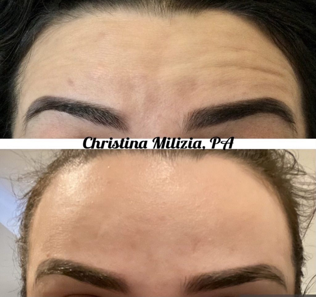 Before and After result Dysport | A Nu U Aesthetics at Congers, New York