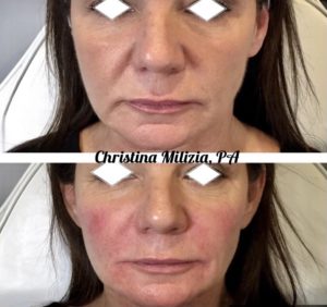 Before and After result Facial Filler Rejuvenation | A Nu U Aesthetics at Congers, New York