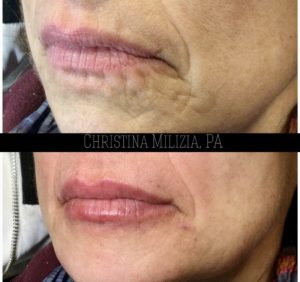 Before and After result Lip Filler | A Nu U Aesthetics at Congers, New York