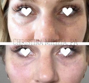 Before and After result under eye fillers | A Nu U Aesthetics at Congers, New York