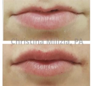 Before and After result Lip Filler | A Nu U Aesthetics at Congers, New York