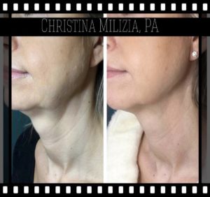 Before and After result Morpheus 8 | A Nu U Aesthetics at Congers, New York