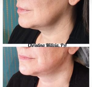 Before and After result PDO Thread Lifts | A Nu U Aesthetics at Congers, New York