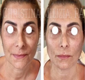 Before and After result PDO Thread Lifts | A Nu U Aesthetics at Congers, New York