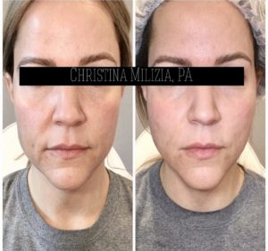 Before and After result PDO Thread Lifts | A Nu U Aesthetics at Congers, New York