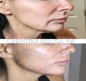 Before and After result PDO Thread Lifts | A Nu U Aesthetics at Congers, New York