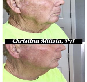 Before and After result PDO Thread Lifts | A Nu U Aesthetics at Congers, New York