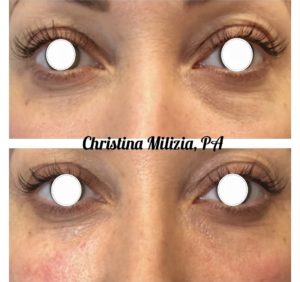 Before and After result under eye fillers | A Nu U Aesthetics at Congers, New York